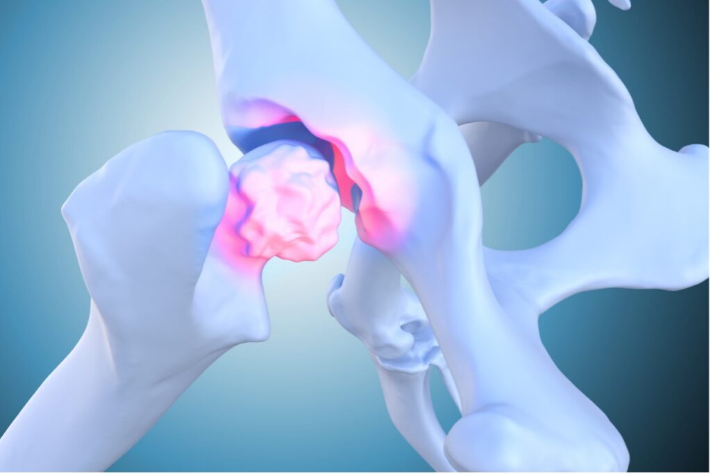 A diagram of a hip bone, Understanding Hip Dysplasia